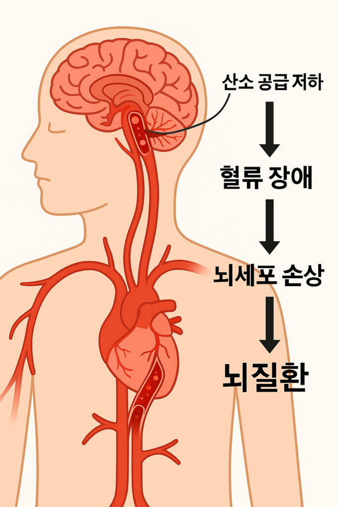  뇌질환과 혈류 관계 이미지