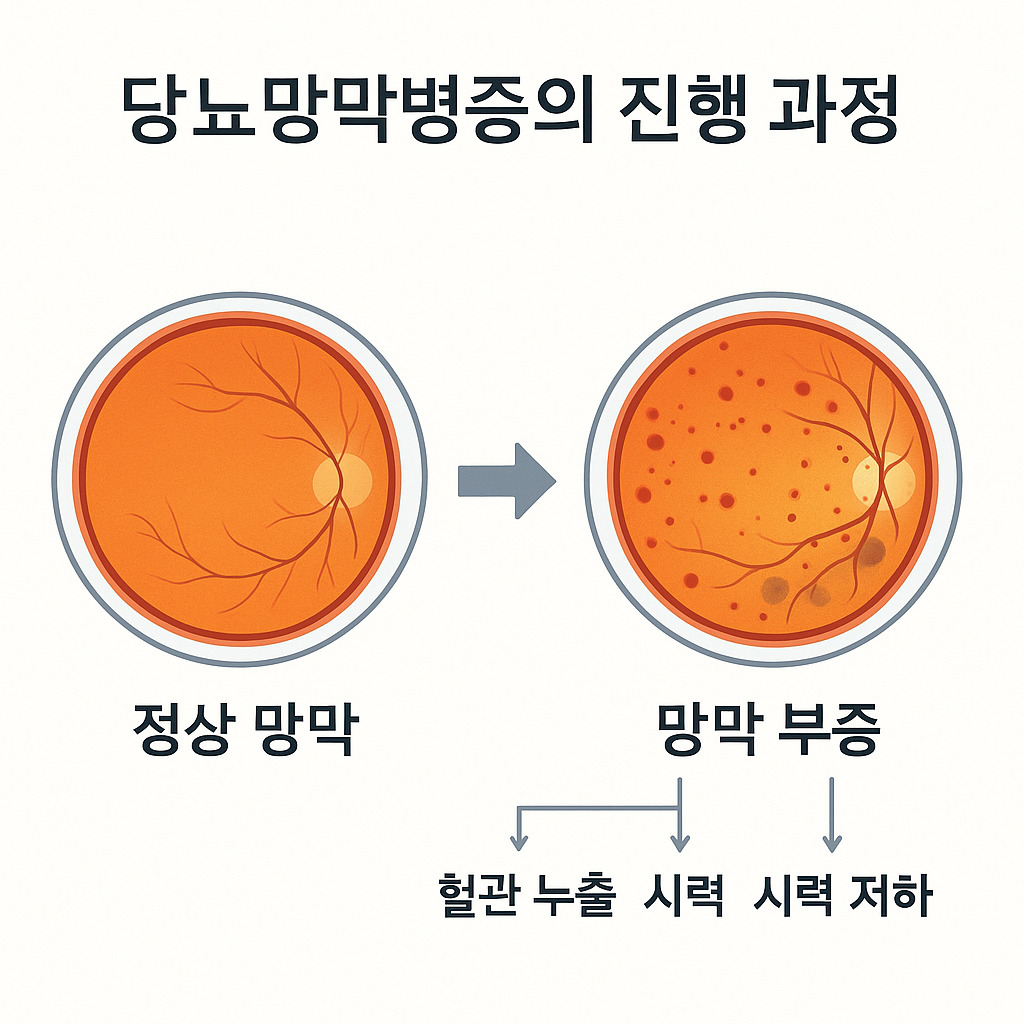 당뇨망막병증의 진행 과정 이미지